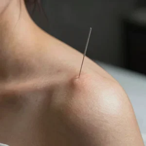Clinical Dry Needling Session